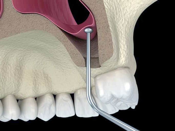 sinus-lift-surgery-in-los-algodones-dental-solutions-algodones