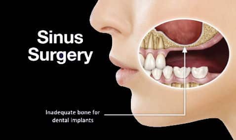 sinus surgery | Los Algodones Dentists