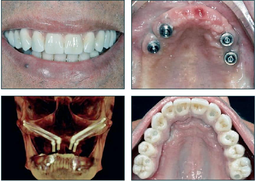 zygomatic implants results | Dental Solutions Algodones