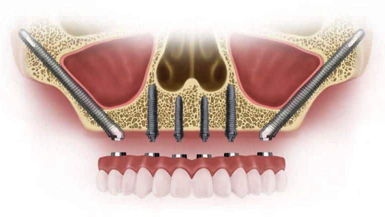 zygomatic implants | Dental Solutions Algodones